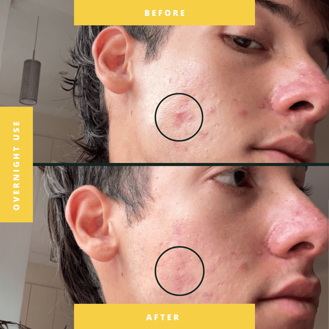 before and after holographic star pimple patch patch project